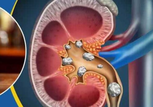 The Effects of Beer on Your Kidneys